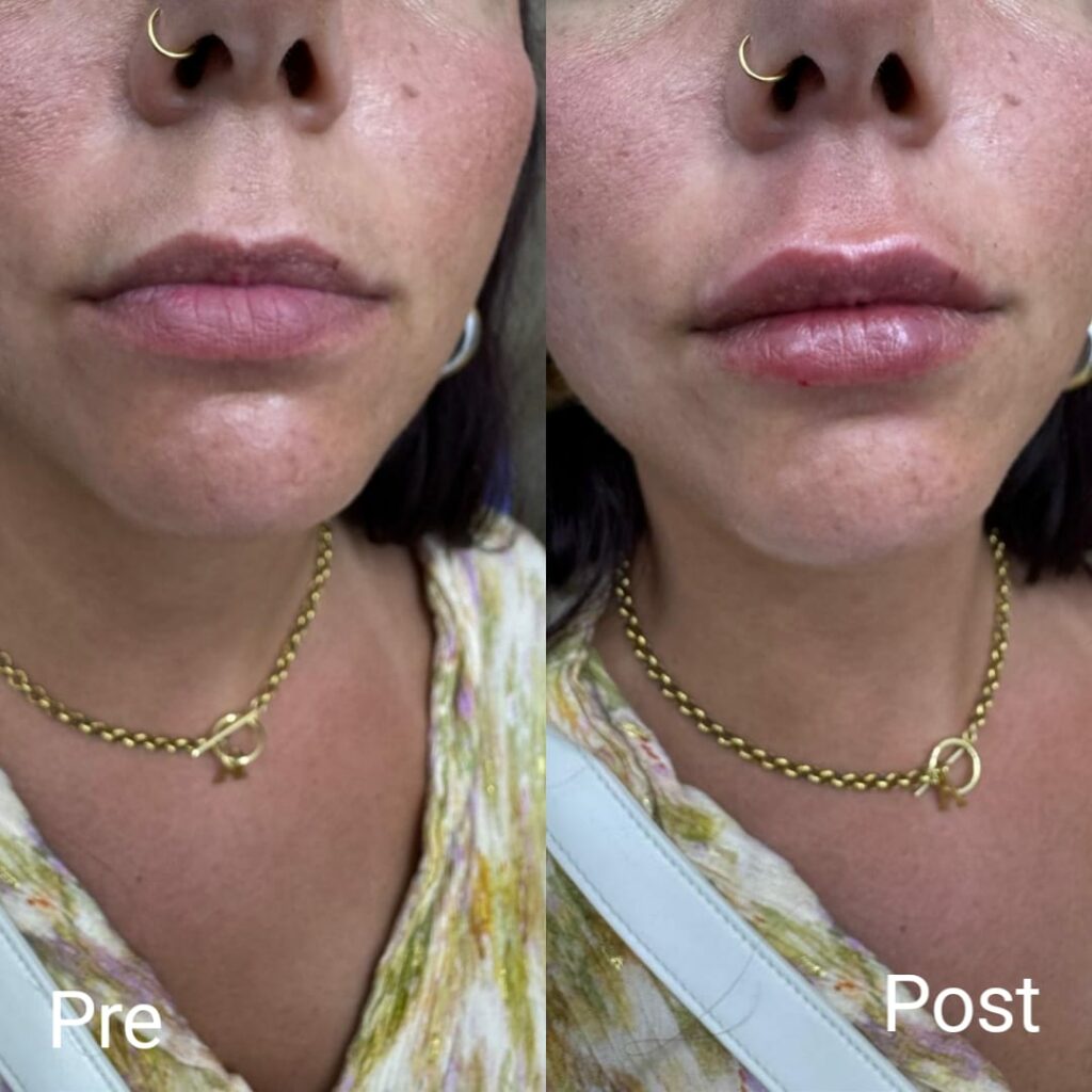 حقن فيلر الشفايف